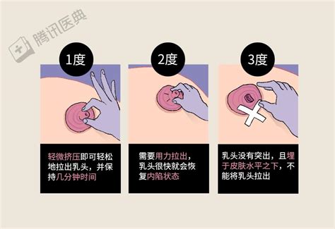 乳暈上一顆一顆|乳暈出現小顆粒可以擠嗎？有很多小顆粒怎麼辦？女醫提醒2件事